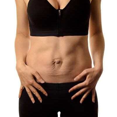 How to Lose Belly Fat With Diastasis Recti